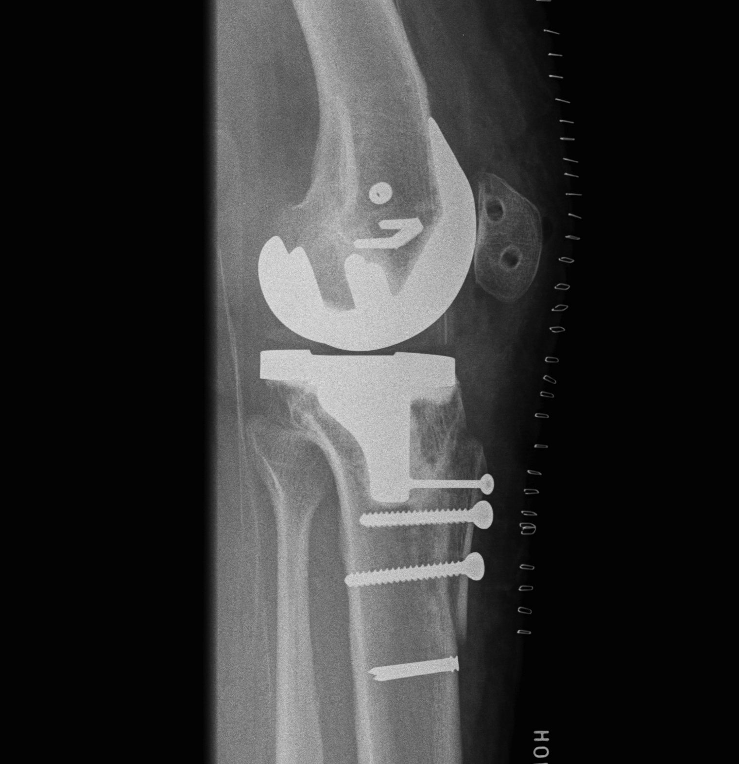 TKR Patella Maltracking TTT MPFL Lateral